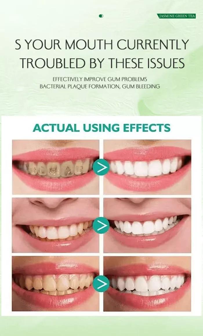 Before and after results using alcohol-free probiotic mouthwash: reduced plaque, healthier gums and brighter teeth Before and after results using alcohol-free probiotic mouthwash: reduced plaque, healthier gums and brighter teeth