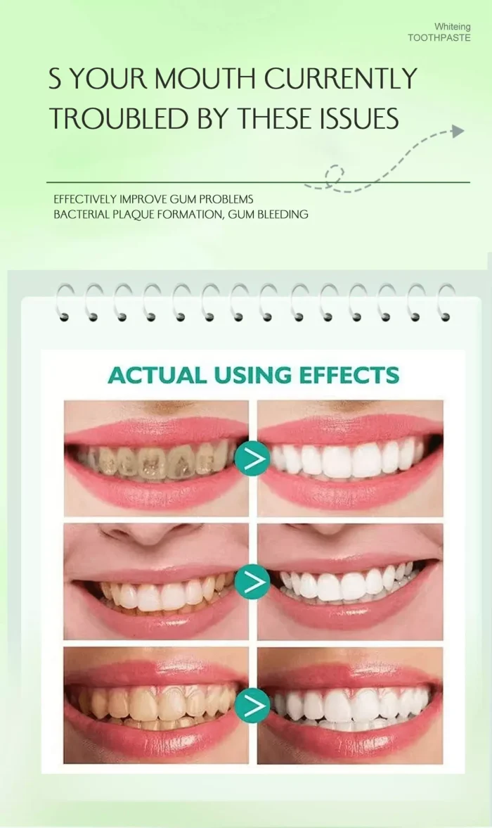 Before and after results using teeth whitening toothpaste – natural stain removal for brighter teeth (individual results may vary) Before and after results using teeth whitening toothpaste – natural stain removal for brighter teeth (individual results may vary)